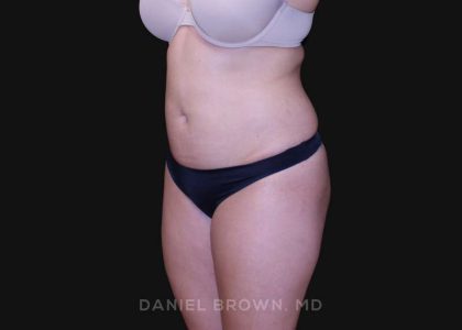 Liposuction Before & After Patient #10246