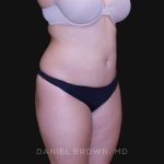 Liposuction Before & After Patient #10246