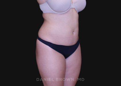 Liposuction Before & After Patient #10246