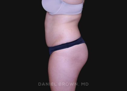 Liposuction Before & After Patient #10246