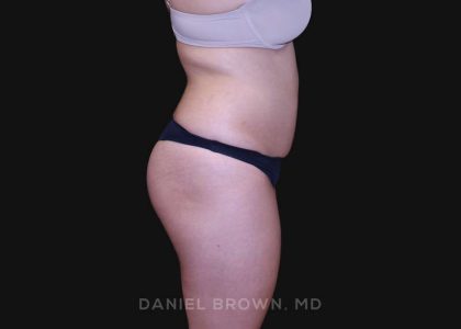 Liposuction Before & After Patient #10246