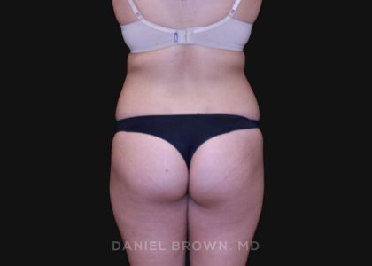 Liposuction Before & After Patient #10246