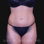 Liposuction Before & After Patient #10257