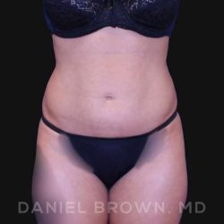 Liposuction Before & After Patient #10257