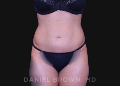 Liposuction Before & After Patient #10257