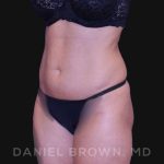 Liposuction Before & After Patient #10257