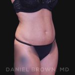 Liposuction Before & After Patient #10257