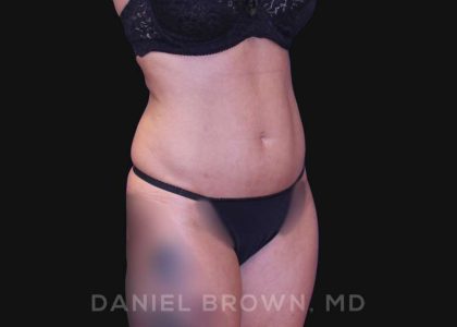 Liposuction Before & After Patient #10257