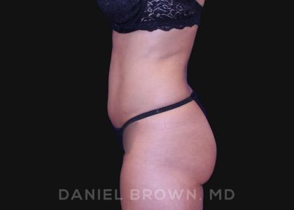Liposuction Before & After Patient #10257