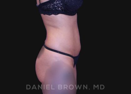 Liposuction Before & After Patient #10257