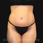 Liposuction Before & After Patient #10257