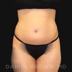 Liposuction Before & After Patient #10257