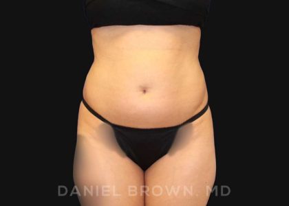 Liposuction Before & After Patient #10257