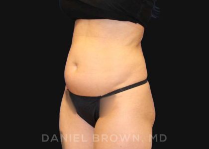 Liposuction Before & After Patient #10257