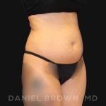 Liposuction Before & After Patient #10257