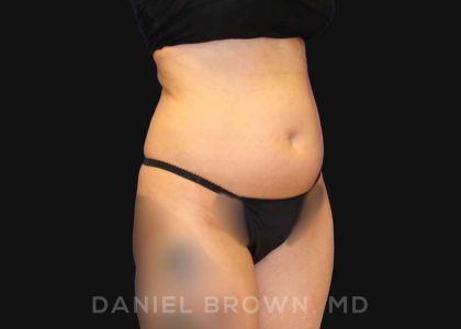 Liposuction Before & After Patient #10257