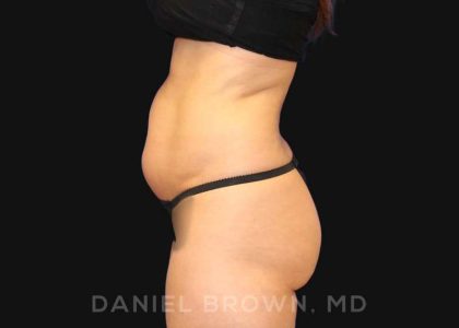 Liposuction Before & After Patient #10257