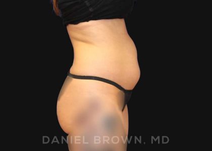 Liposuction Before & After Patient #10257