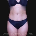 Liposuction Before & After Patient #10280