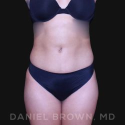Liposuction Before & After Patient #10280