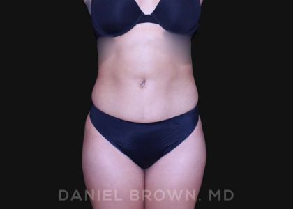 Liposuction Before & After Patient #10280
