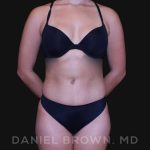 Liposuction Before & After Patient #10280