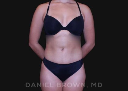 Liposuction Before & After Patient #10280
