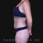 Liposuction Before & After Patient #10280