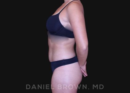 Liposuction Before & After Patient #10280