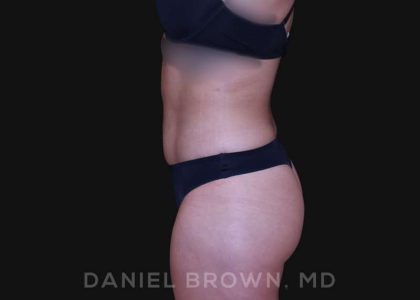 Liposuction Before & After Patient #10280
