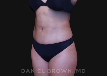 Liposuction Before & After Patient #10280