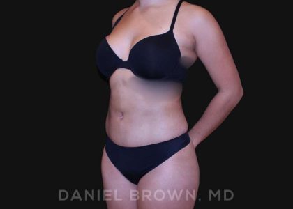 Liposuction Before & After Patient #10280