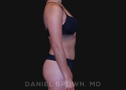 Liposuction Before & After Patient #10280
