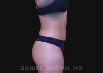 Liposuction Before & After Patient #10280