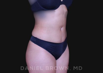 Liposuction Before & After Patient #10280