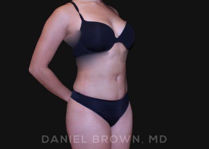 Liposuction Before & After Patient #10280