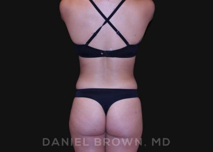 Liposuction Before & After Patient #10280