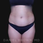 Liposuction Before & After Patient #10280