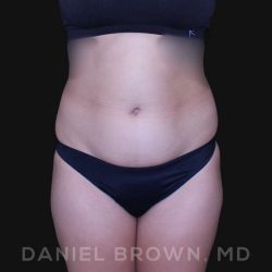 Liposuction Before & After Patient #10280