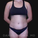Liposuction Before & After Patient #10280