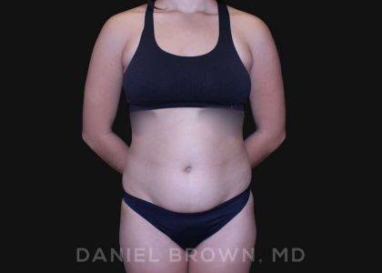 Liposuction Before & After Patient #10280