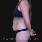 Liposuction Before & After Patient #10280