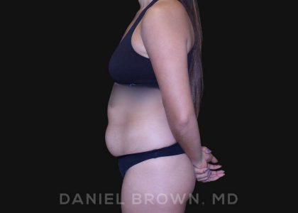 Liposuction Before & After Patient #10280