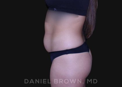 Liposuction Before & After Patient #10280