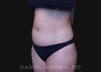 Liposuction Before & After Patient #10280