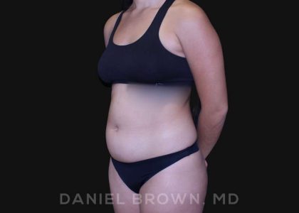 Liposuction Before & After Patient #10280