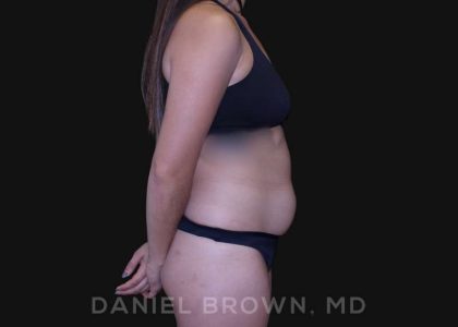 Liposuction Before & After Patient #10280