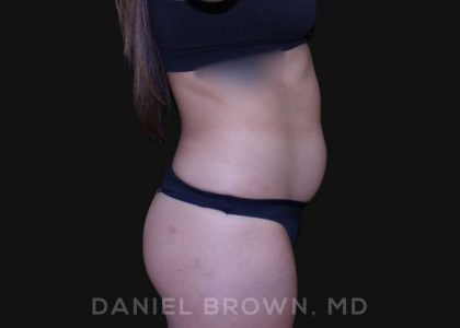 Liposuction Before & After Patient #10280