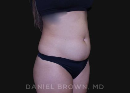 Liposuction Before & After Patient #10280