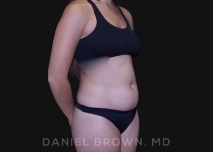 Liposuction Before & After Patient #10280
